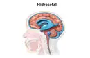 Normal Basınçlı Hidrosefali
