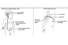 Hidrosefali Şant Özellikleri ve Faydaları Nelerdir?