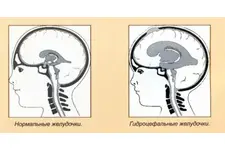 Yetişkinlerde Hidrosefali Belirtileri ve Tedavisi