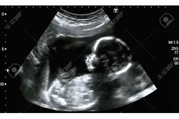 Gebelikte Hidrosefali Tedavisi