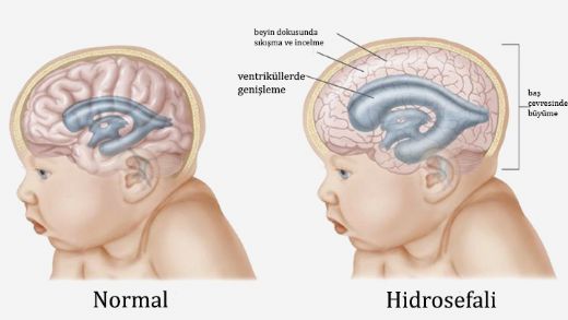Hidrosefali Belirtileri ve Tedavisi