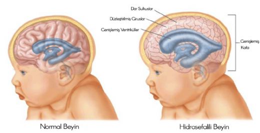 Hidrosefali Genetik mi?