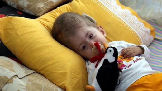 Hidrosefali Hastaları Ne Kadar Yaşar?