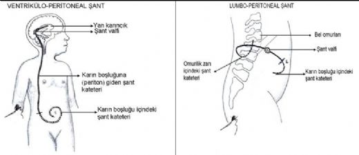 Hidrosefali Şant Özellikleri ve Faydaları Nelerdir?