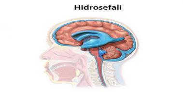 Normal Basnl Hidrosefali